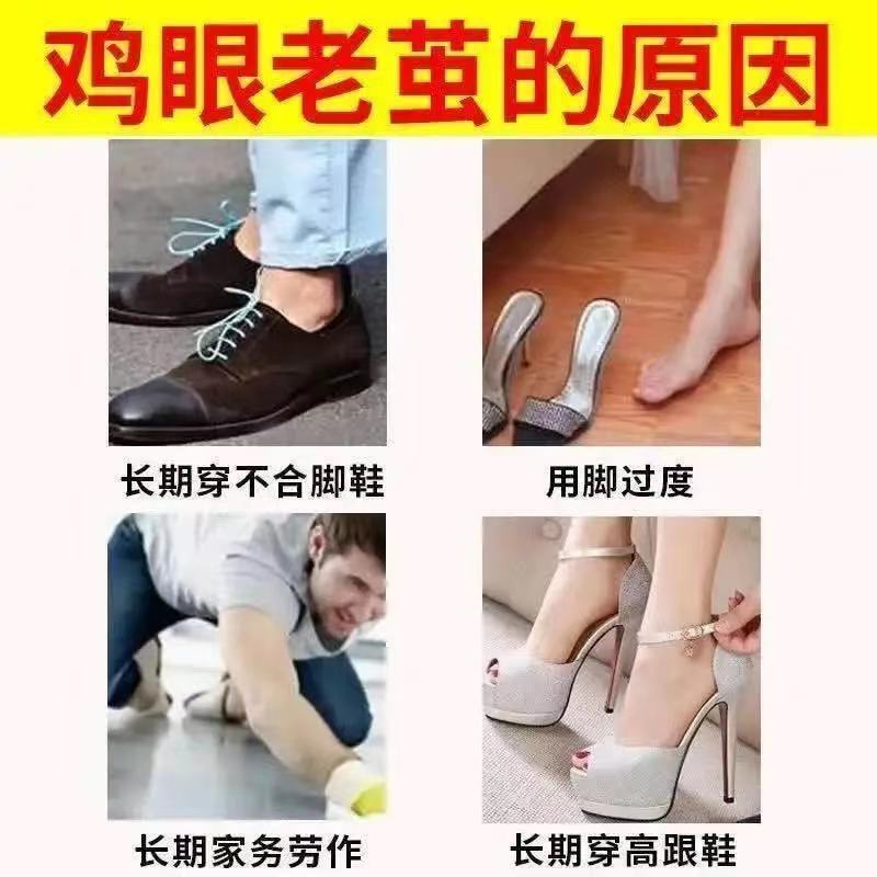 Dụng cụ hỗ trợ tách hạt bắp cho ngón chân và bàn chân tay【hl