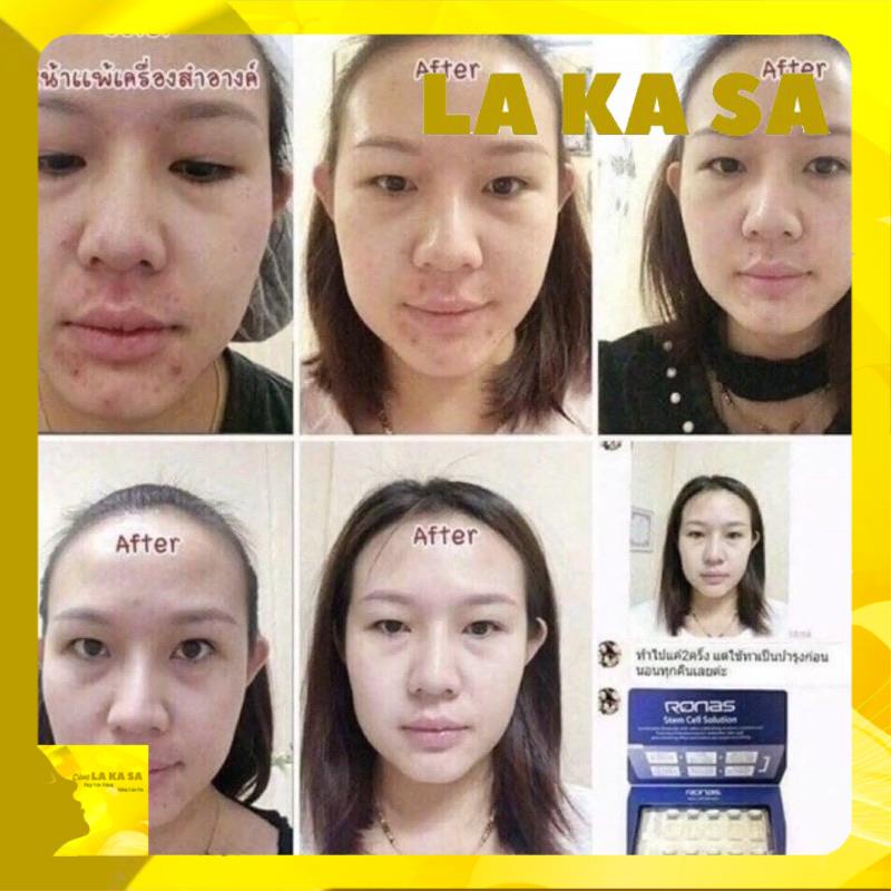 Tế Bào Gốc Ronas Trắng Da - Ngăn Ngừa Lão Hoá Korea ( Tách lẻ 1 lọ và 5 lọ)