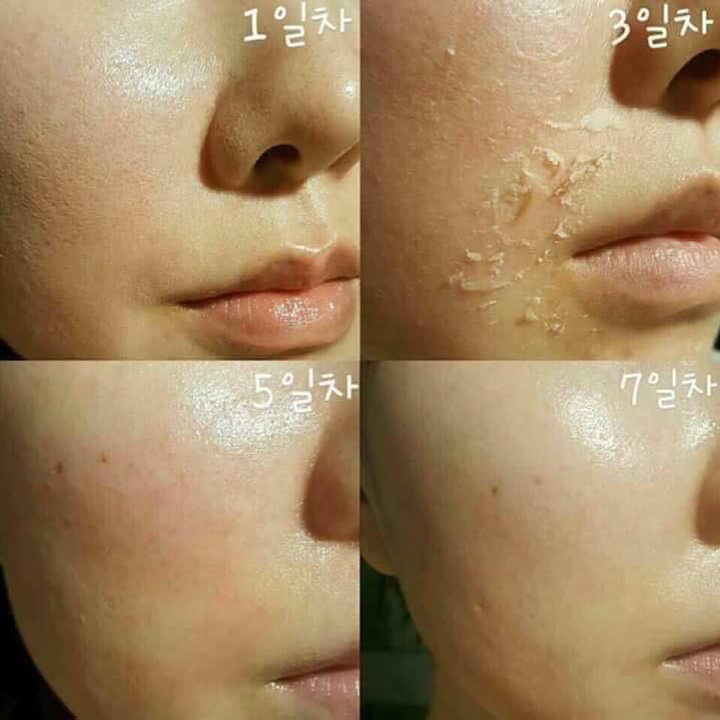 Bộ Thay Da Sinh Học Matrigen B-Tox Peel Của Hàn Quốc