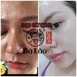 Sạch Mụn Cao Cấp Bà Lão - Sạch Mụn Liền Da