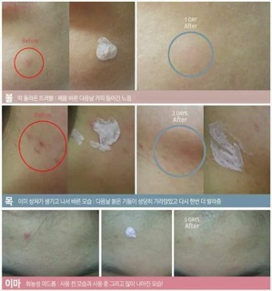 Chấm Mụn 𝐁𝐘𝐄 𝐁𝐘𝐄 𝐁𝐋𝐄𝐌𝐈𝐒𝐇 𝐃𝐫𝐲𝐢𝐧𝐠 𝐋𝐨𝐭𝐢𝐨𝐧