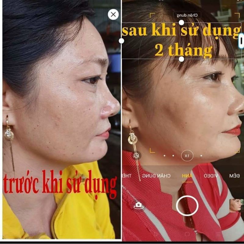 Kem_trị_nám