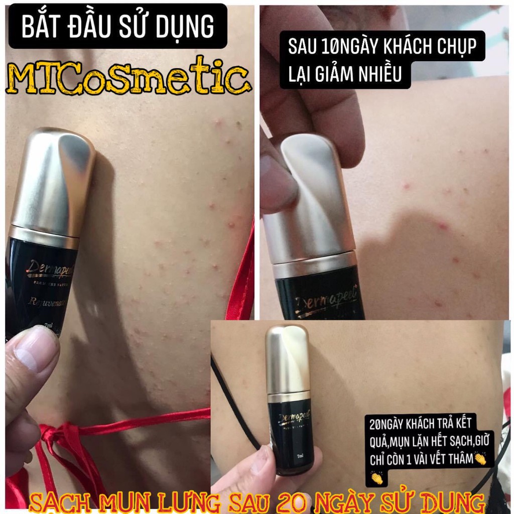 SERUM Dermapeel+ TRỨNG CÁ TUYẾT - XÓA MỤN - Mờ THÂM MỤN - Se Khít LCL - DA CĂNG BÓNG - TRẮNG SÁNG SAU 14 NGÀY