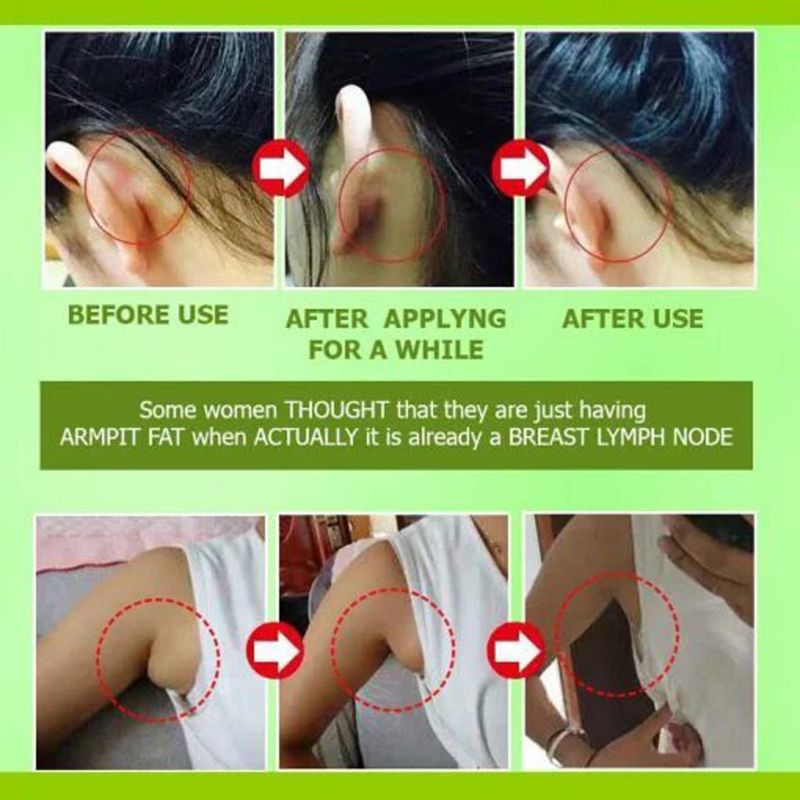 Miếng Dán Thải Độc Vùng Cổ Chống Sưng