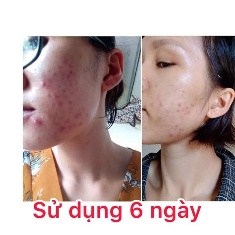 Serum đánh bay mụn 11day Linh Hương | BigBuy360 - bigbuy360.vn