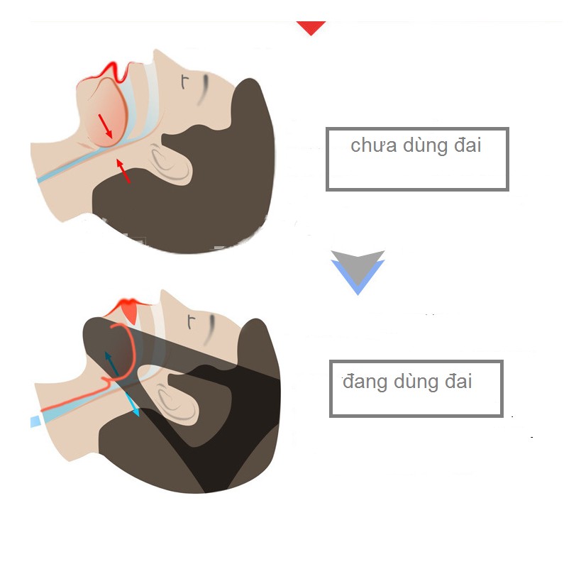 Đai chống ngủ ngáy