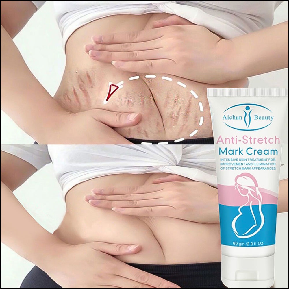 kem rạn da Kem xóa nhăn Kem loại bỏ sẹo 60g làm mờ vết rạn sau sinh Chống nếp nhăn do giảm cân Sửa chữa tổn thương da