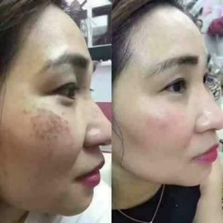 Bộ sản phẩm CLOBETAMIL G cao cấp