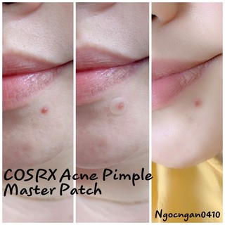 Miếng Dán Mụn Cosrx Master Patch
