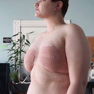 Keo vải dán ngực Tomboy