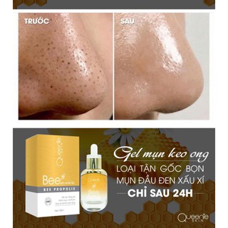 GEL MỤN KEO ONG