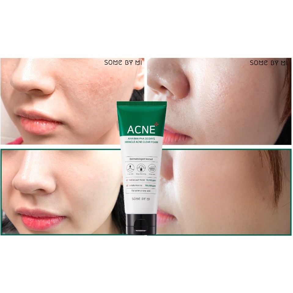 Sữa Rửa Mặt Làm Giảm, Ngăn Ngừa Mụn Some By Mi AHA BHA PHA 30 Days Miracle ACNE Clear Foam 100ml