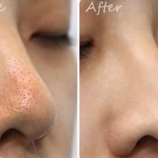 Lotion se khít lỗ chân lông
