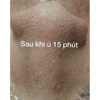 Ủ mụn đầu đen, mụn cám YOUNGER 30ml