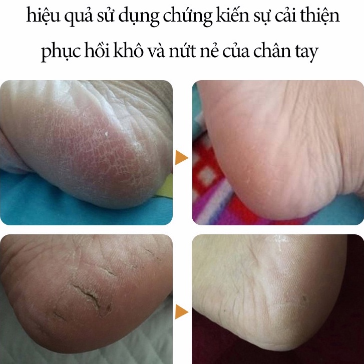 Kem dưỡng da tay Kem dầu ngựa Kem phục hồi da chân tay 30g phục hồi khô của chân tay dưỡng ẩm cải thiện thô ráp nếp nhăn