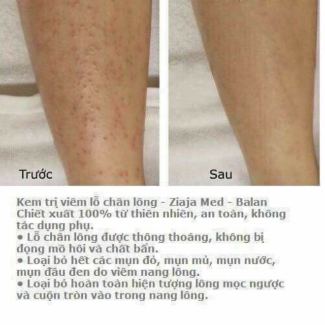 Kem Trị Viêm Lỗ Chân Lông Ziaja Med