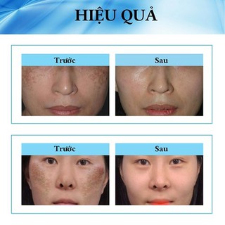Sét nám đỏ 𝐝𝐮̛𝐨̛̃𝐧𝐠 𝐭𝐫𝐚̆́𝐧𝐠 𝐝𝐚 Thái lan