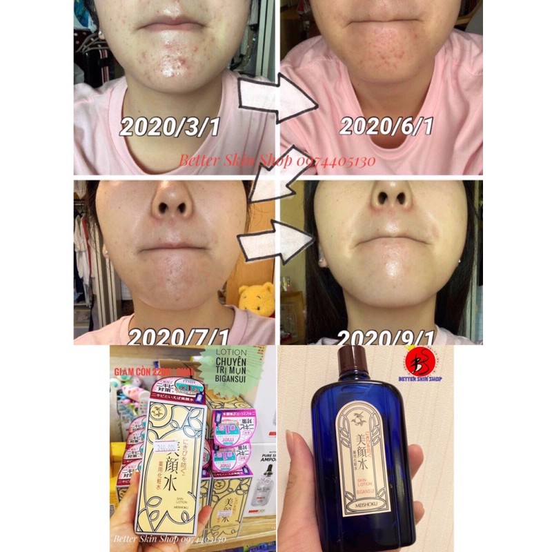 Lotion Bigansui giảm mụn