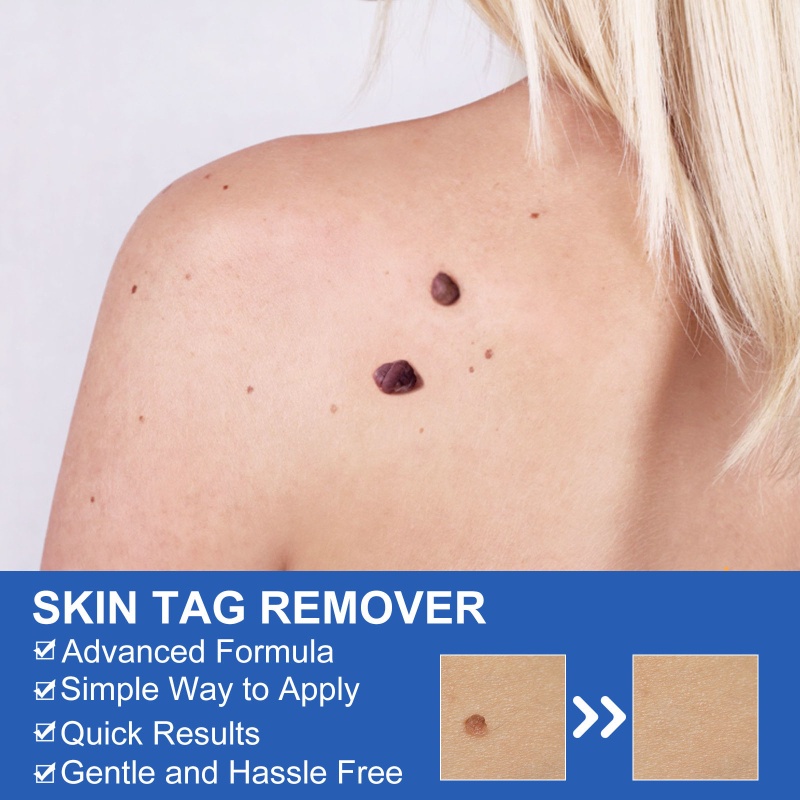 Bộ Dụng Cụ Loại Bỏ Mụn Thịt Dư Trên Da 2 Trong 1 (1mm-9mm)