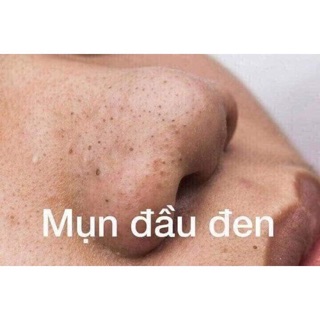 Gel lột mụn Huyền Phi 120k
