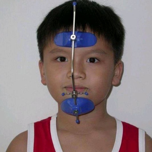 Facemask chỉnh nha