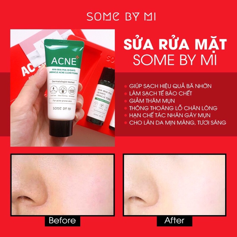 Bộ Kit Some By Mi Miracle Starter Kit cho da dầu mụn (4 Items)