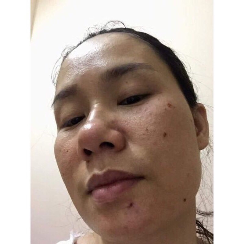 detox Acnes serum-serum loại bỏ mụn Kamel 10ml | BigBuy360 - bigbuy360.vn