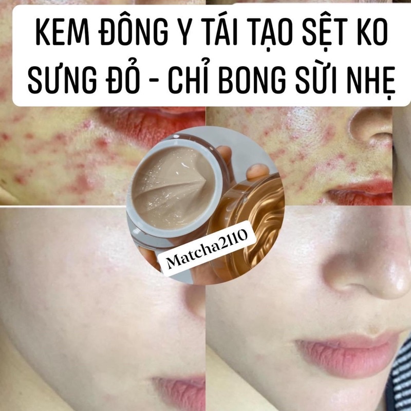 kem tái tạo đông y sệt handmade (ko sưng ko đỏ)