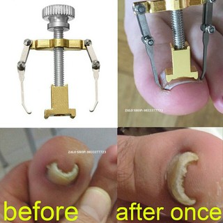 BỘ DỤNG CỤ CHỮA MÓNG CHÂN BỊ CHỌC THỊT GÂY TỔN THƯƠNG ĐAU ĐƠN -MÓNG CHÂN BỊ QUẶP THỊT