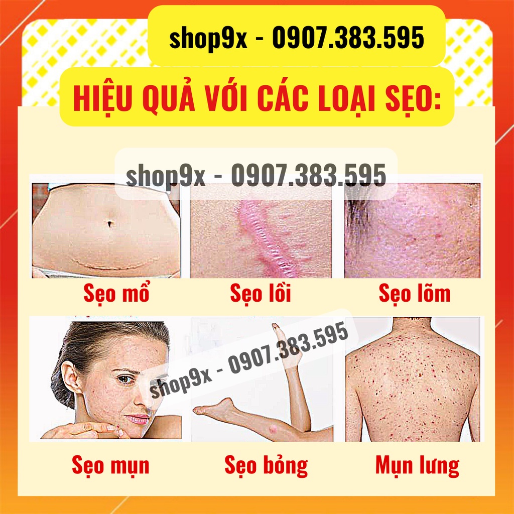 Kem Mờ Sẹo Mờ Thâm Peimei - Kem Giảm Sẹo Và Rạn Da - Chống Sẹo Lồi Sẹo Lõm Hiệu Quả Sau 1 Tuần 30gr // Shop9X