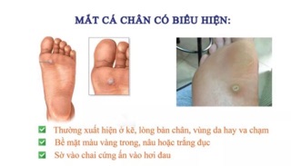 [CHÍNH HÃNG] Miếng Dán Mụn Cóc Plaster