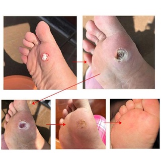 Miếng dán mụn cơm, mụn cóc, mắt cá chân, chai chân 1 bộ 6 miếng