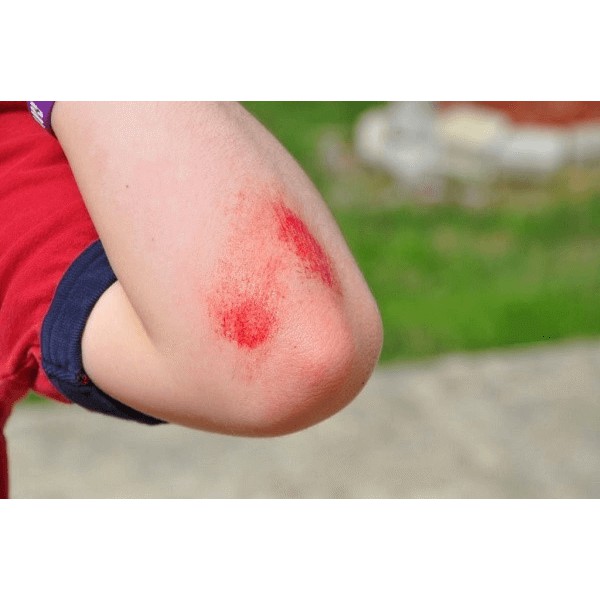 Kem Mỡ Kháng Sinh Neosporin, Xịt Sát Trùng Vết Thương Của Mỹ