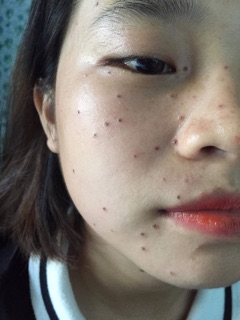 CHẤM CHÂN TÀN NHANG,NỐT RUỒI,MỤN THỊT