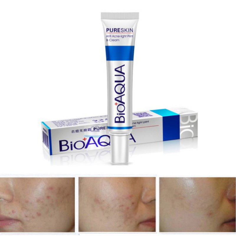 [Hàng mới về] Kem hỗ trợ giảm mụn Bioaqua cải thiện mụn trứng cá kiềm dầu sáng da 30g