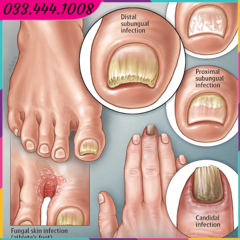 Kem Nấm Móng Tay Chân CLOTHASONE-D CREAM 15g - Thái Lan - Gò Vấp