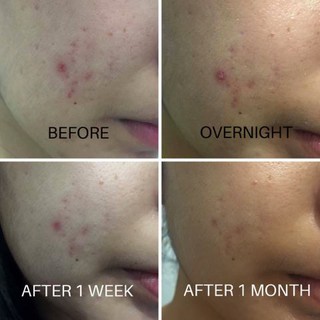 Kem Dưỡng Cosrx Centella Blemish Cream 30gr