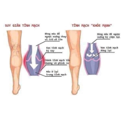 Kem trị suy giãn tĩnh mạch PhiloSoft (Thái lan) siêu tốt | BigBuy360 - bigbuy360.vn