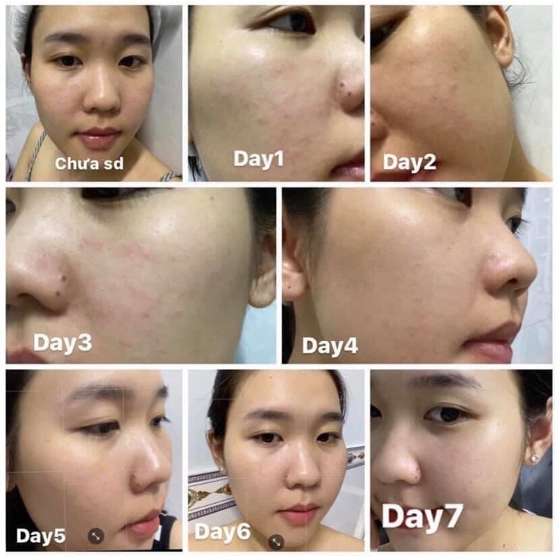 [Mã SKAMSALE8 giảm 10% đơn 200K] [CHÍNH HÃNG ]CAO MỤN SÂM ĐỎ -36vị thuốc quý | BigBuy360 - bigbuy360.vn