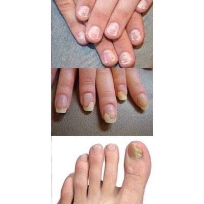 Dung dịch cải thiện nấm móng Varisi Nail