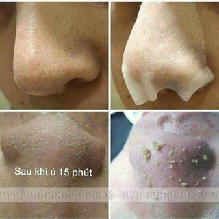 MIẾNG DÁN ĐẨY MỤN ĐẦU ĐEN ciracle goodbye blackhead Hàn Quốc