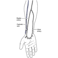 mắt mèo phản quang mẫu lục giác gắn Ex Winner Raider Sirius Wave Drem...full bát