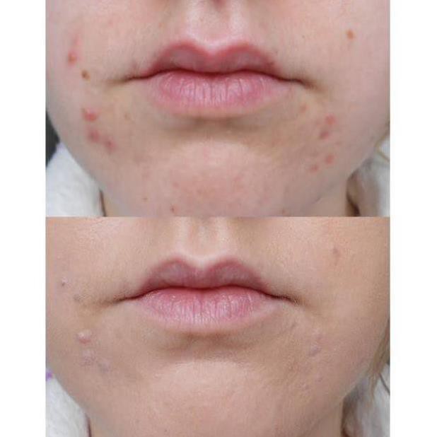 Gel Chấm Mụn T-Zone 8ml