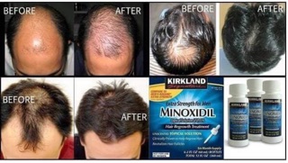 dung dịch Mọc Tóc Minoxidil 5% Kirkland date 1/26