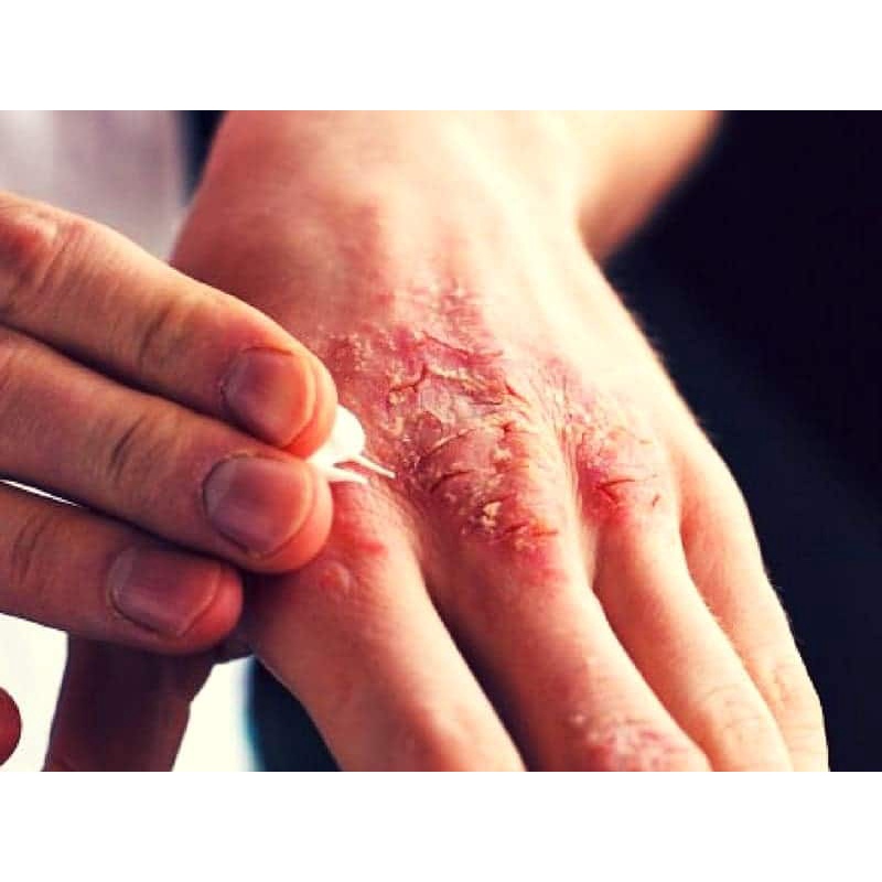 Thảo Dược quý Hết hẳn Chàm Ngứa, Ghẻ Nước, Nước ăn Chân _Hết Ngứa ngay