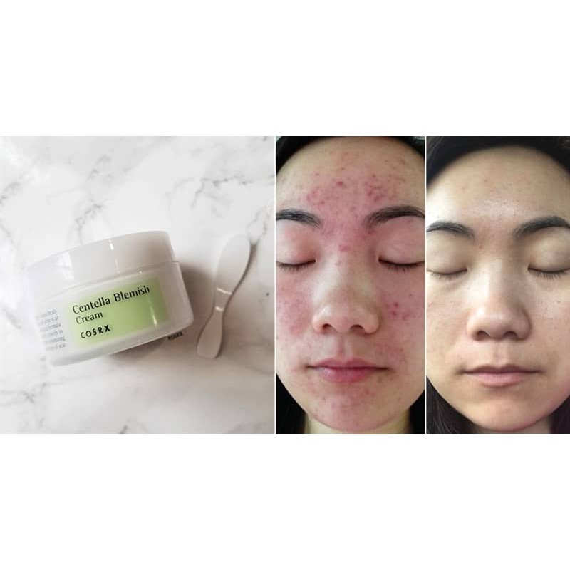 ‼️‼️Kem Dưỡng Giảm Mụn Cosrx Centella Blemish Cream 30gr‼️‼️ (chính hãng)