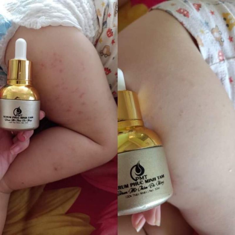 SERUM MỜ THÂM PHÚC MINH TÂM