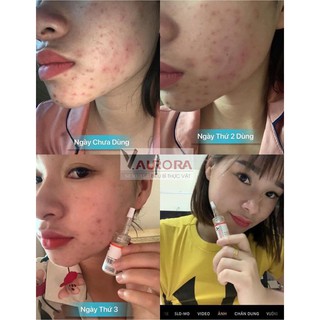 (Combo 3 lọ) Serum biểu bì thực vật V-AURORA