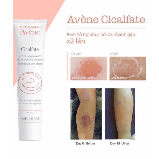 [FREE SHIP] Kem dưỡng phục hồi mờ thâm sẹo AVENE