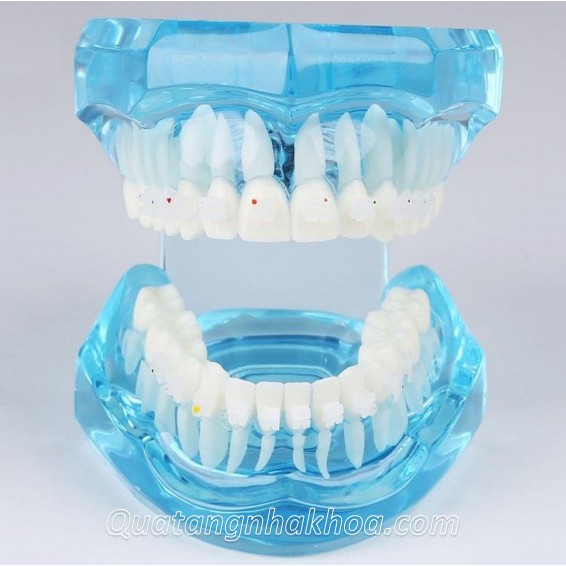 Mẫu hàm tư vấn chỉnh nha mắc cài sứ – mô hình nắn chỉnh răng nha khoa